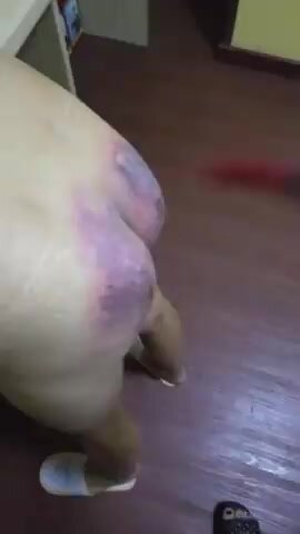Bruised Ebony Ass - Butt bruising punishment - ThisVid.com