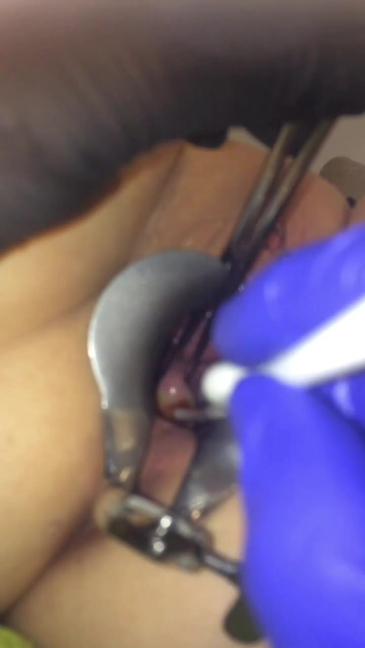 Cervix torture extreme gyno - ThisVid.com