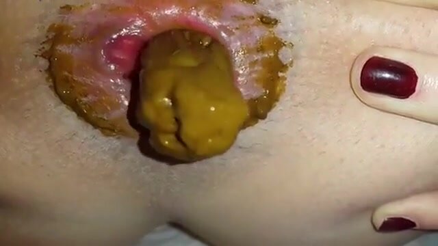 Bloody Anal Fuck - Anal prolapse while pooping and bloody pussy - ThisVid.com