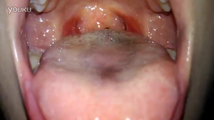 Husband examines his wife's tonsils - ThisVid.com