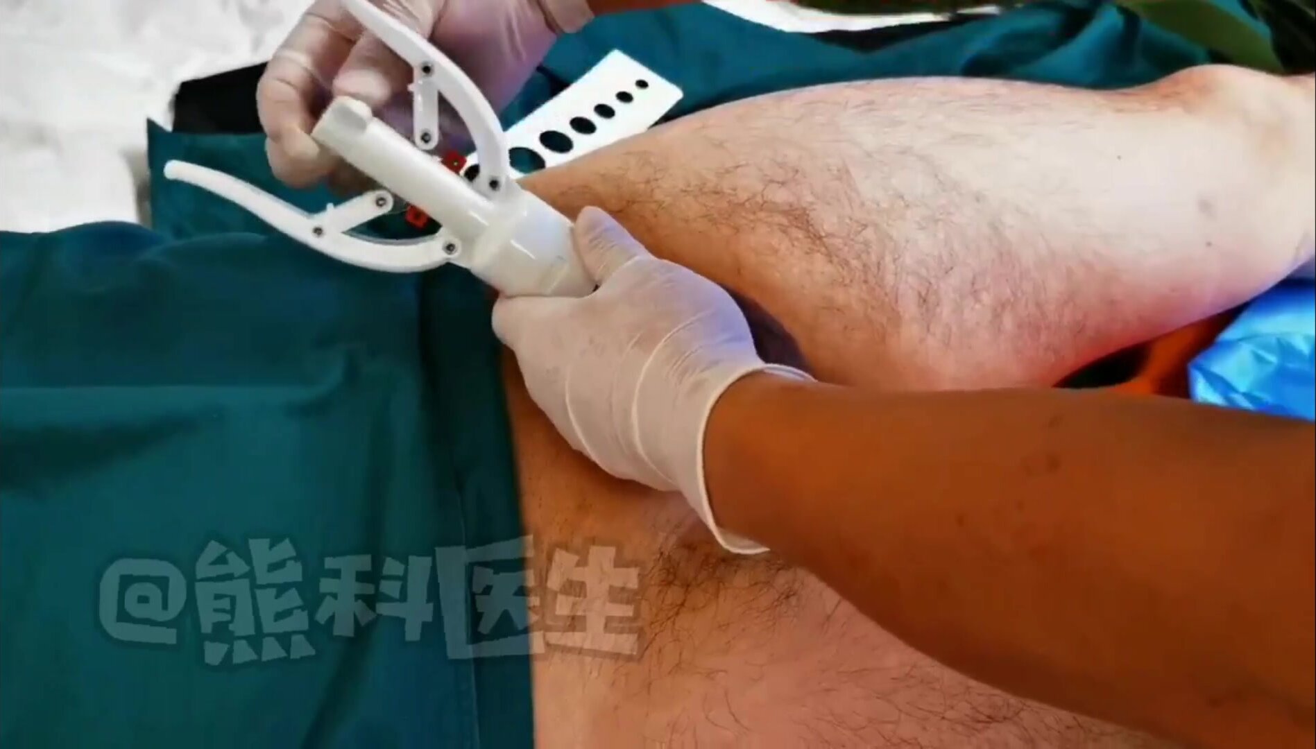 Stapler circumcision without anesthetic - ThisVid.com