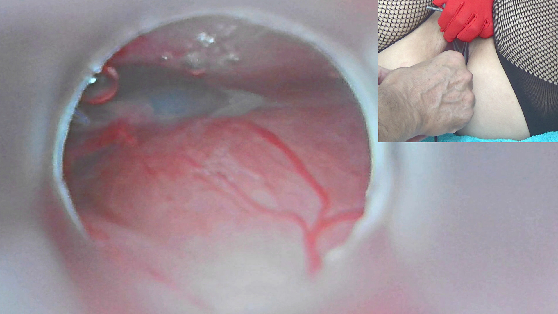 Insemination Cum into Uterus and Endoscope Camera hq nude picture