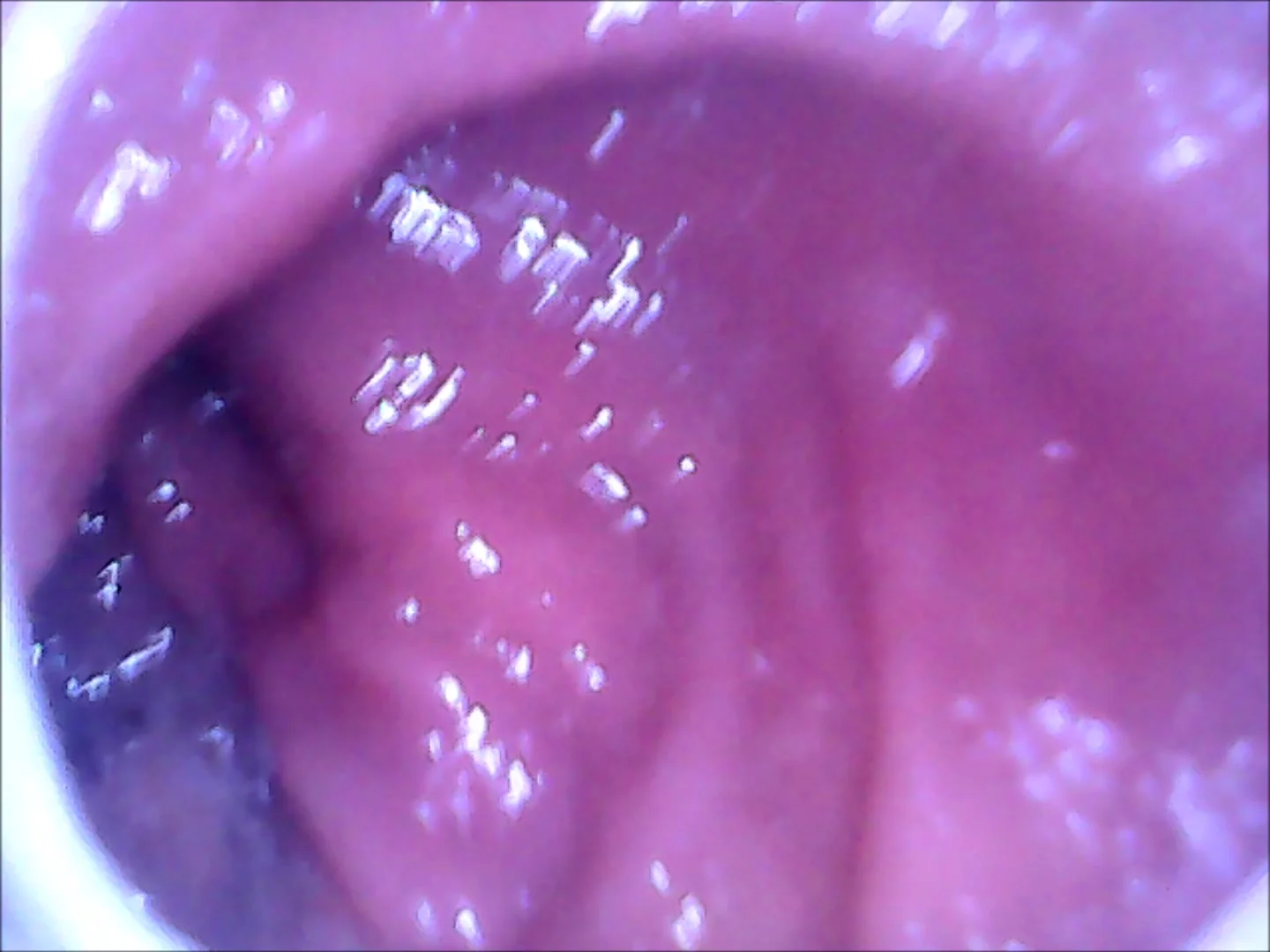 Internal Asshole - Endoscope camera inside my ass - ThisVid.com