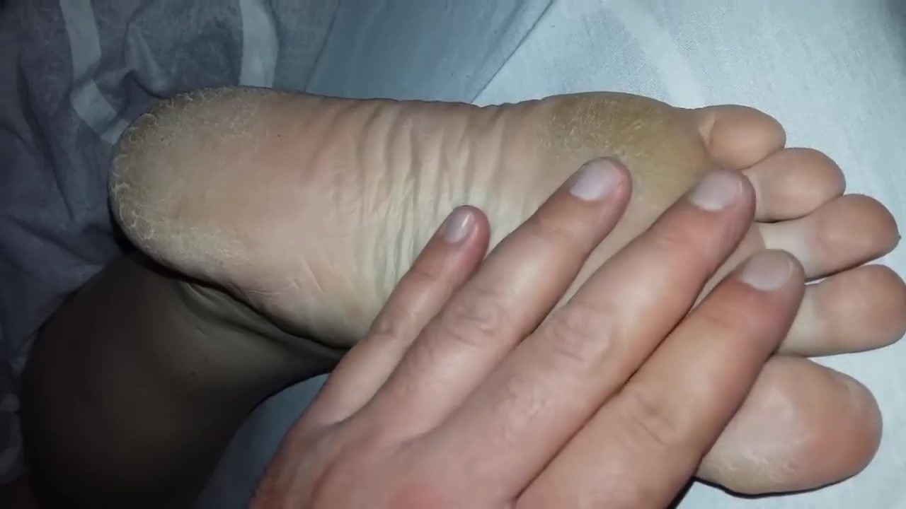 Dry Feet Porn - Cracked Heels - ThisVid.com