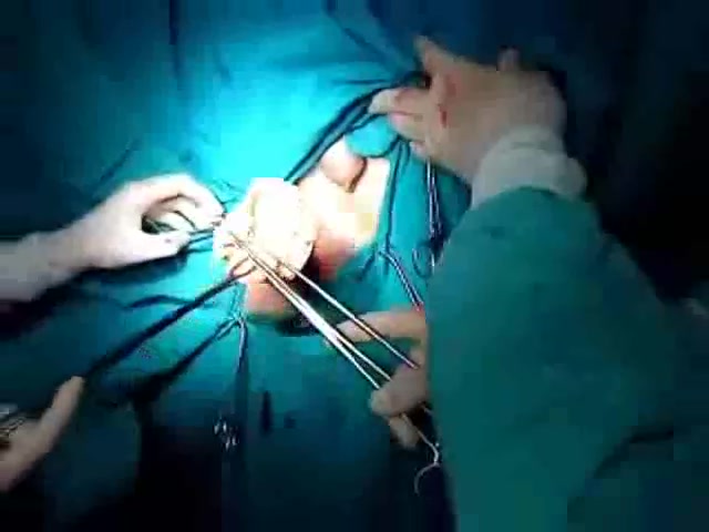 Surgeons remove a dildo from an ass