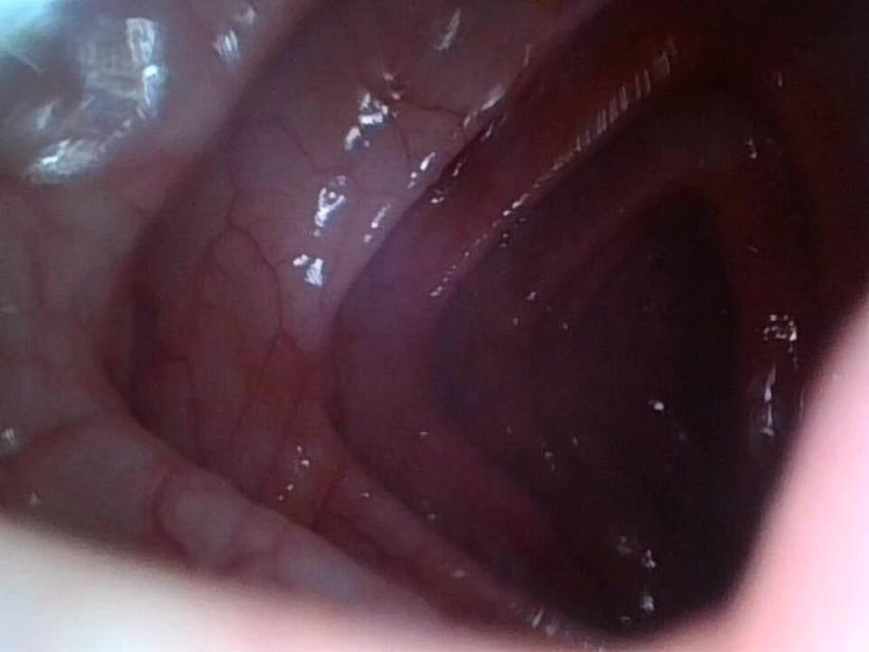 960px x 720px - Endoscopy found uneaten residue in the colon - ThisVid.com