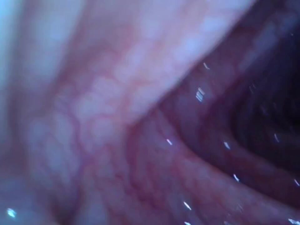 Colon Cam - Endoscopy deep inside my girl friend's colon - ThisVid.com