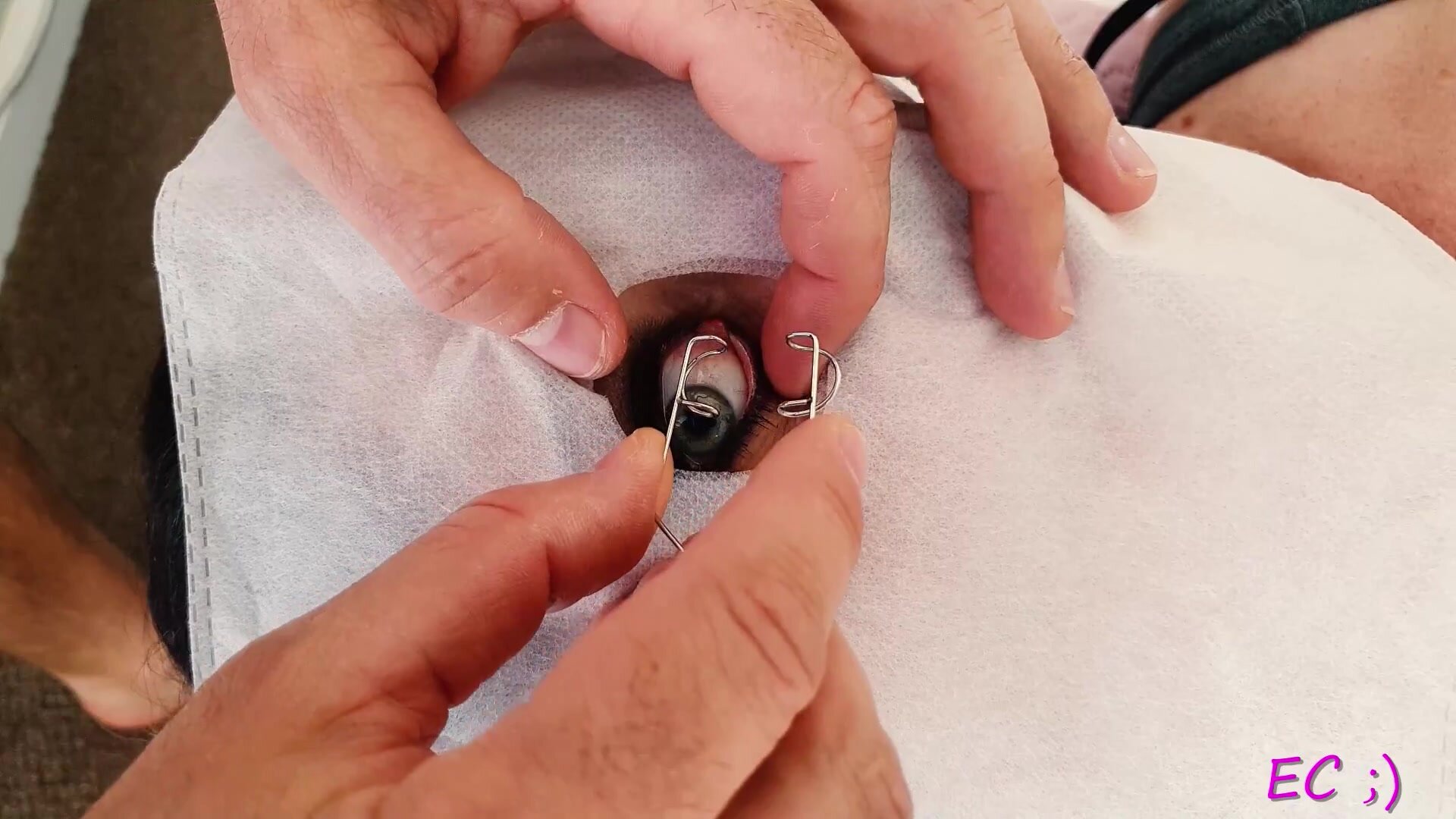 Eye speculum porn - a-lohas.jp