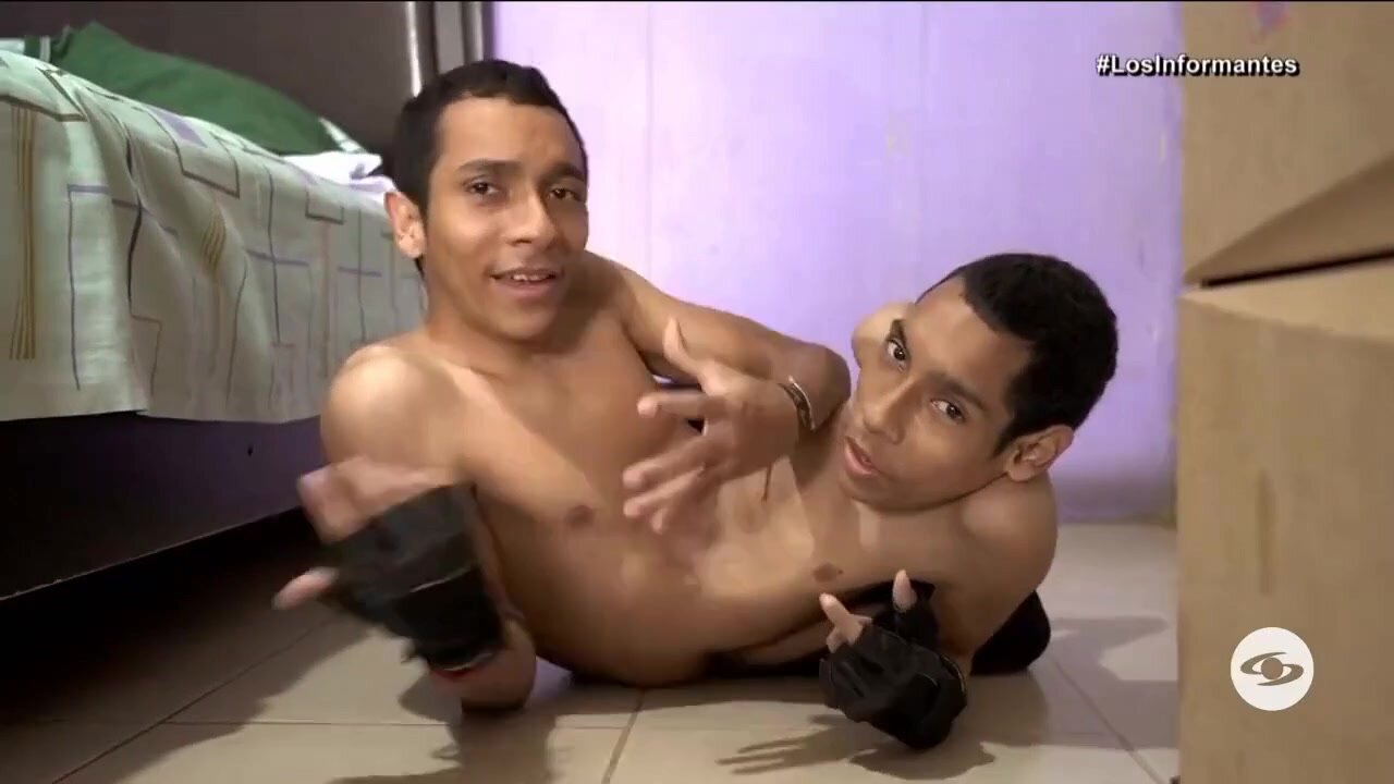 Nude conjoined twins