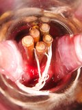Laminary sticks in the cervix