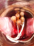 Laminary sticks in the cervix