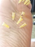 Needles in soles feet foot 2