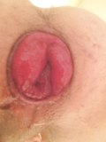 Pumping loose anal to an extreme prolapse