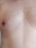 Removing nipples