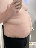 N2o belly inflation / before & after pics