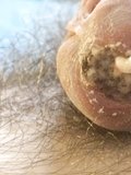 Maggots inside peehole