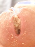 Maggots inside peehole