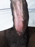 Fully subincision cock