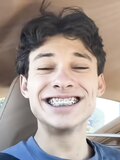 Braces fillings and mouths
