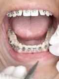 Braces fillings and mouths