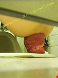 Chinese Woman Enormous Prolapse