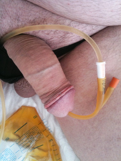 Catheter with Peebag