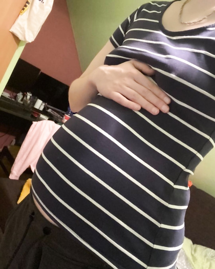 After Bloat in Striped Shirt