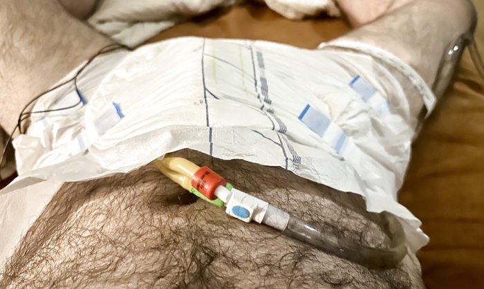 Catheterized and Diapered