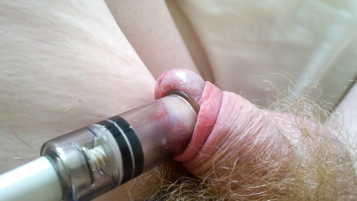 Suction session