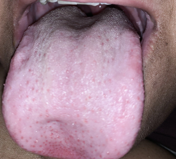 Tongue And Uvula Fetish Image 373307 Thisvid Tube