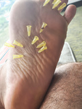 Needles in soles feet foot - album 2