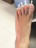 Needles (Left Foot)