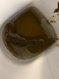 Hard poop