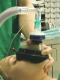 Anesthesia  and intubated