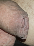 foreskin and softie