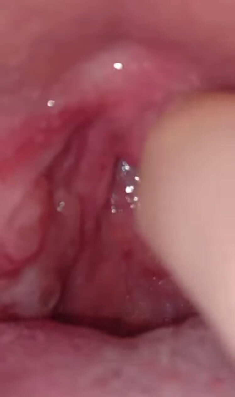 Uvula Tickle - video 2