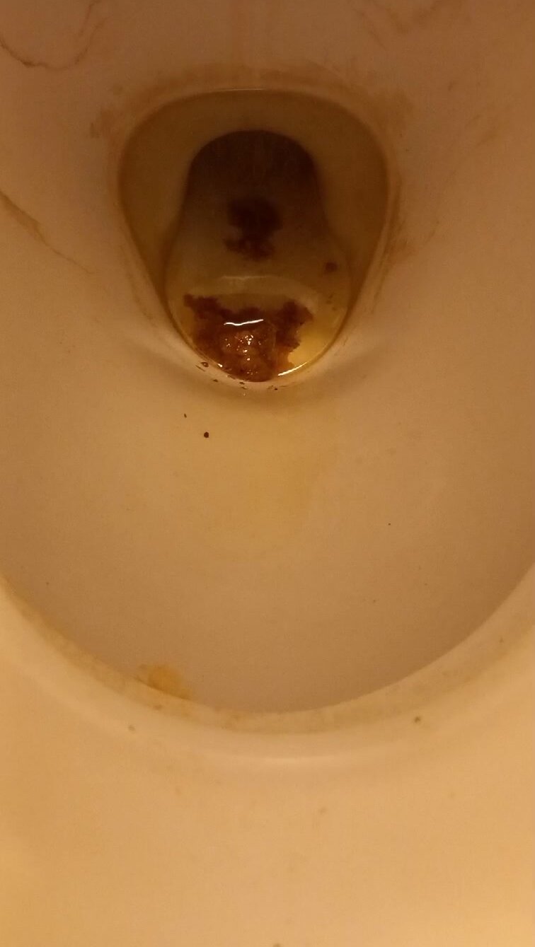 diarrhea and wet fart