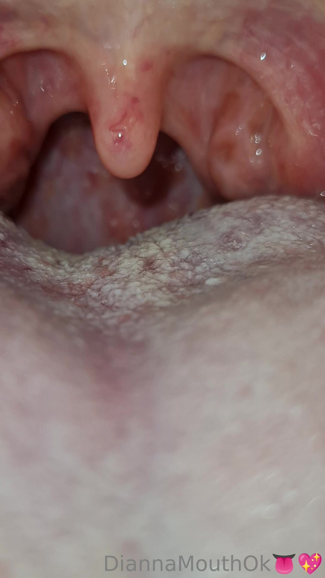Sick and Swollen Womans Throat