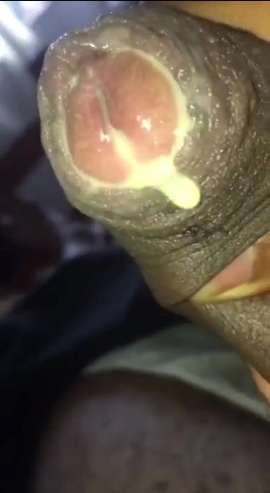 Gonorrhea discharge - ThisVid.com