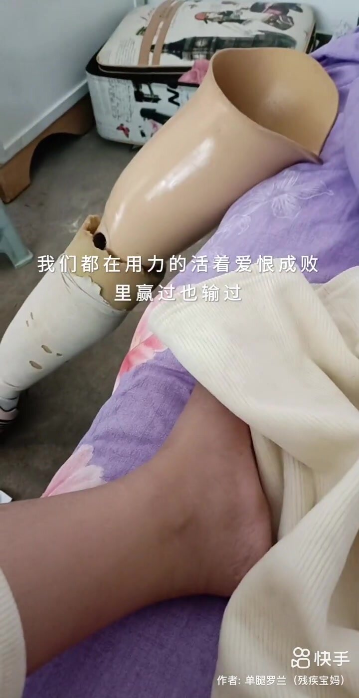 SAK amputee shows prosthetic leg