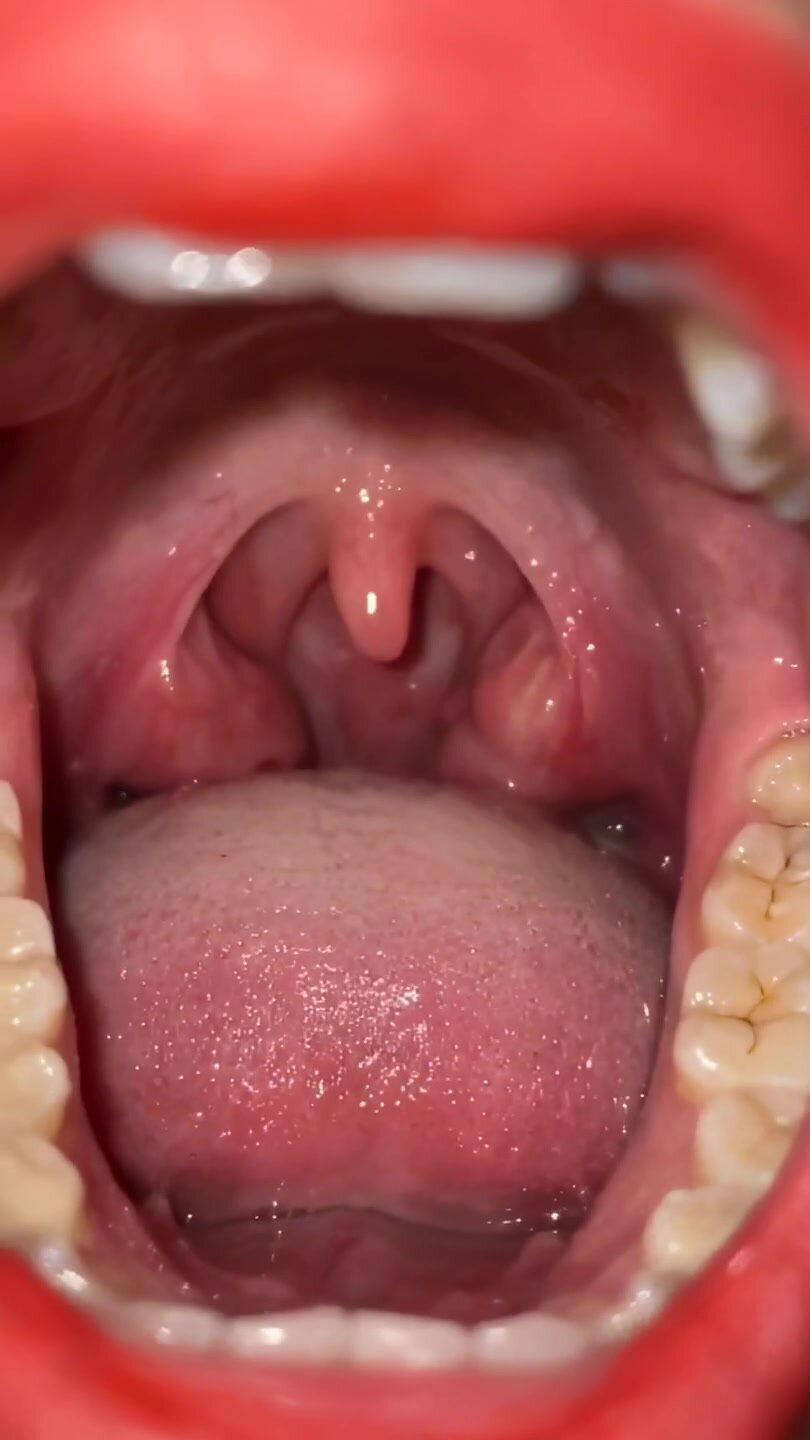 girl uvula X-1