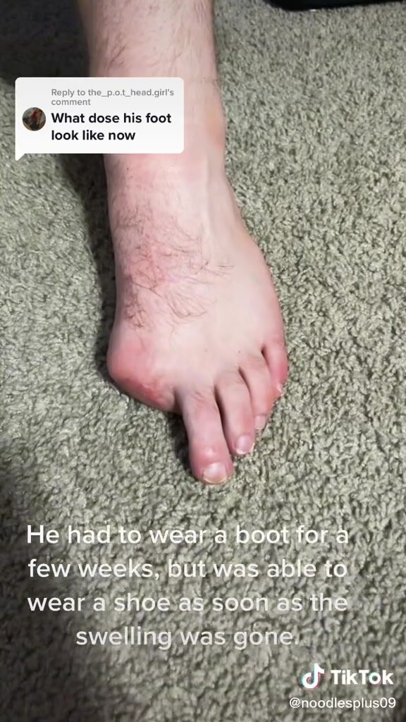 amputated big toe