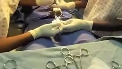 Gomco Circumcision