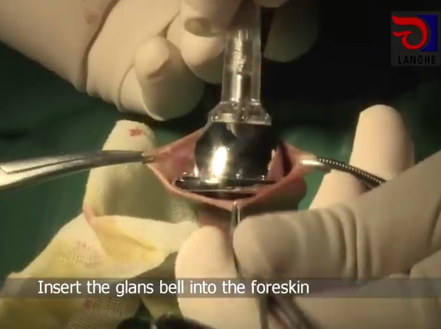 Correct method for stapler circumcision