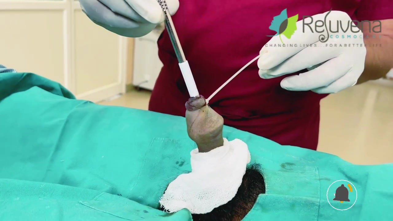 Circumcision process with stapler