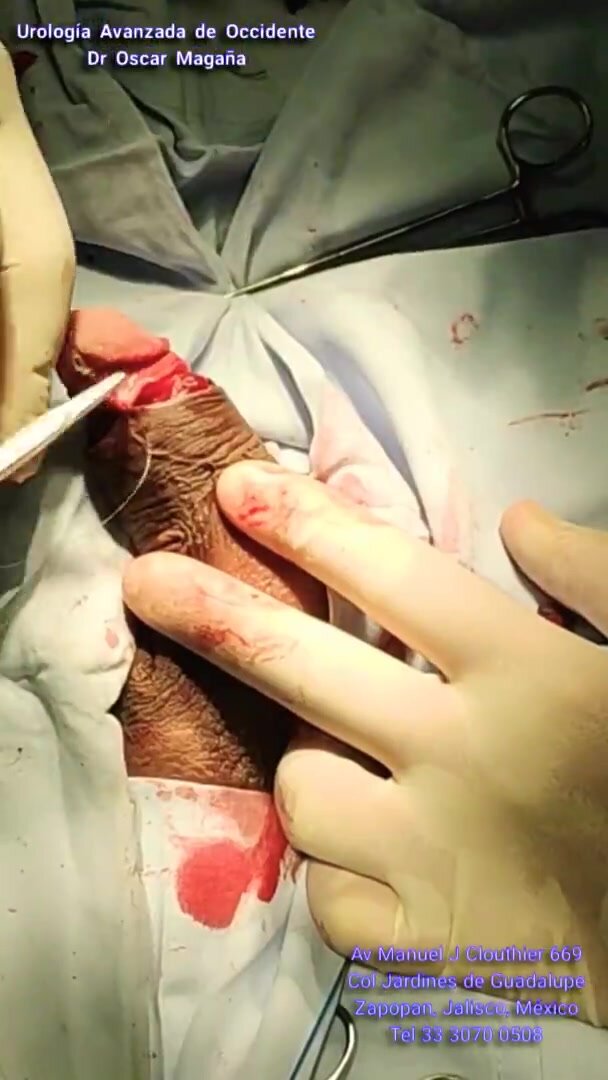 Circumcision with laser