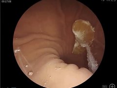 Observation of oranges in a girl's stomach through caps
