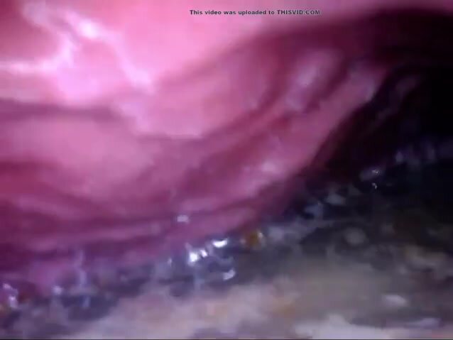 Endoscopic video of a Chinese girl