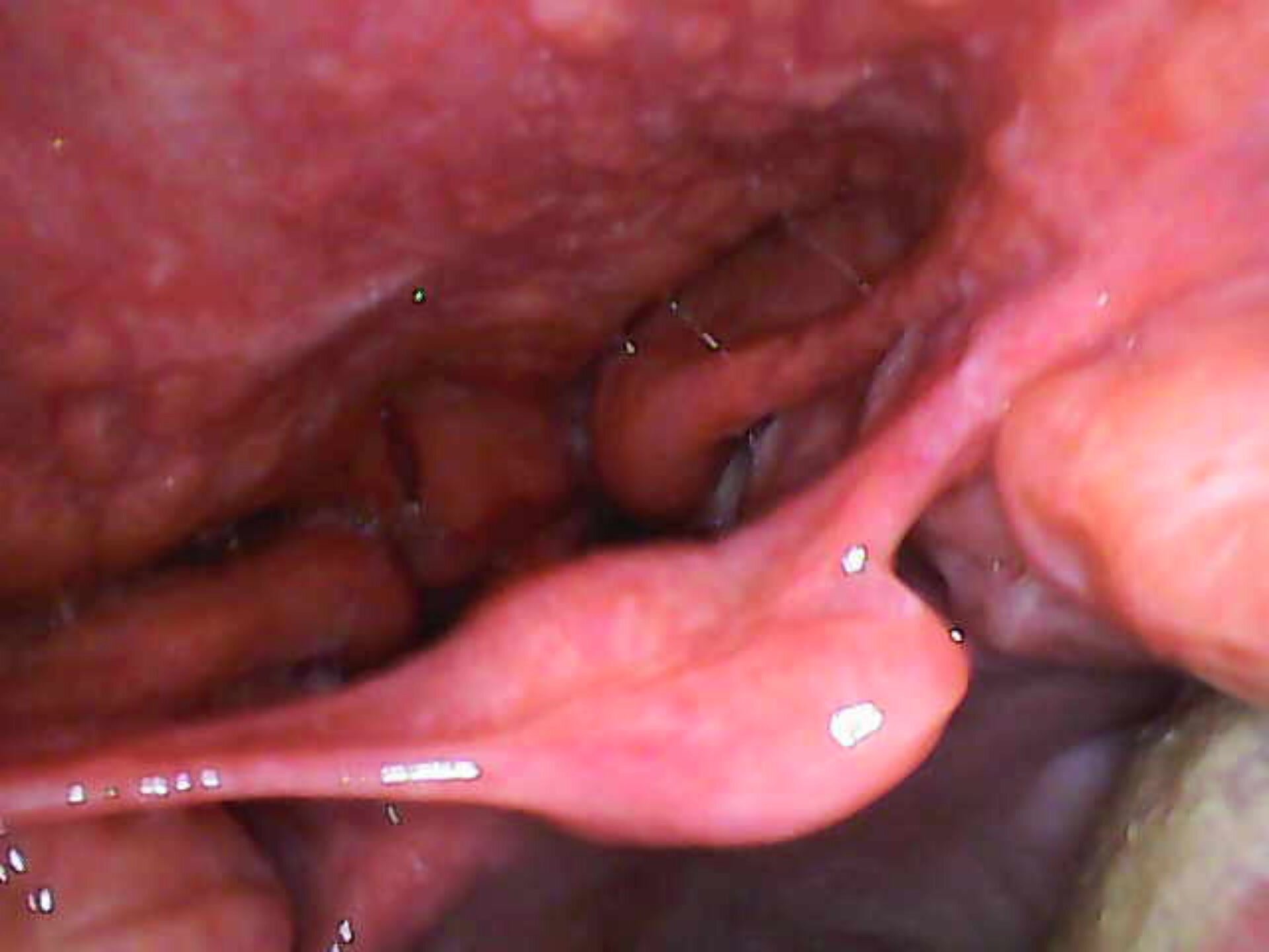reverse uvula