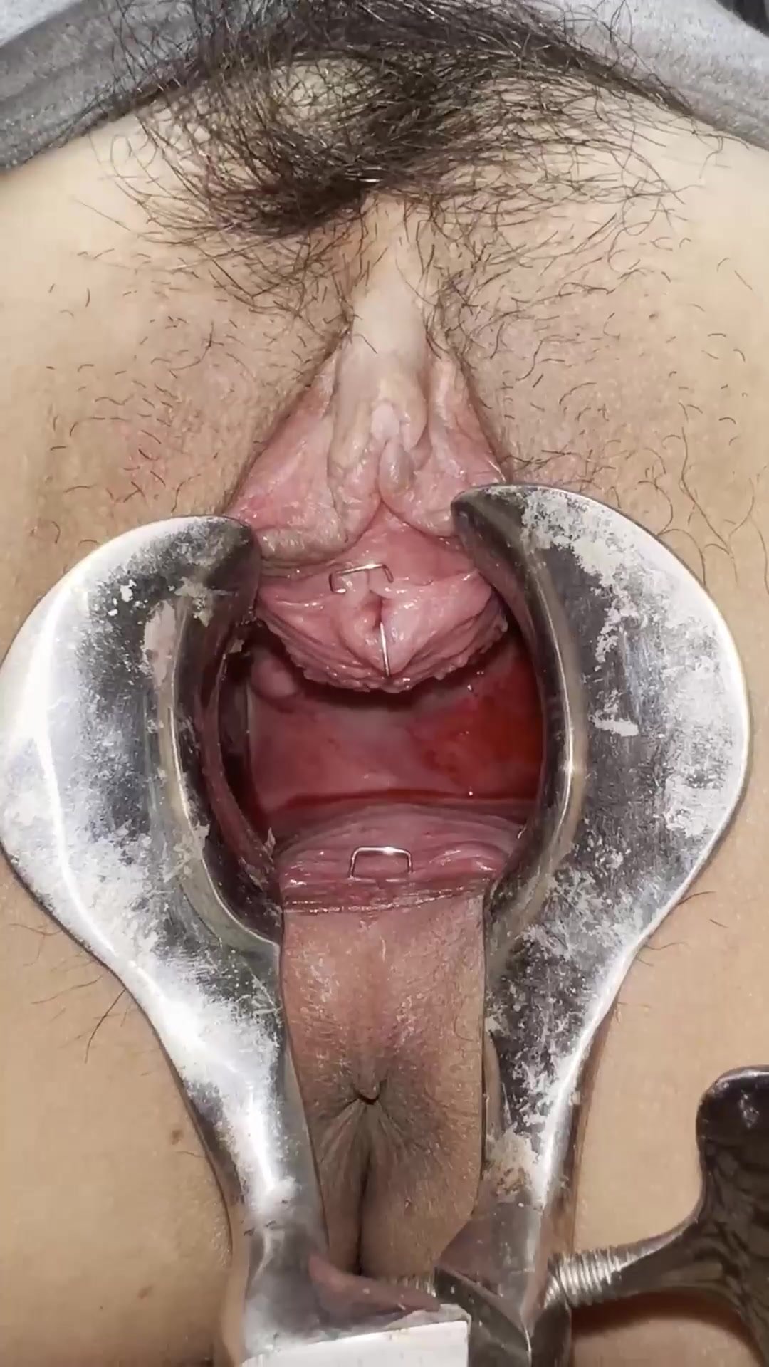 Urethra and pussy stapled